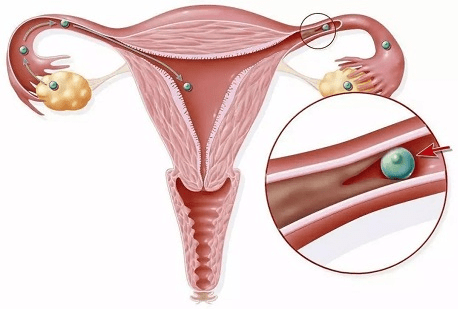 疏通输卵管堵塞有什么症状_输卵管堵塞怎么疏通_堵塞疏通输卵管的幸孕方法